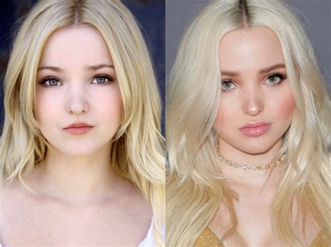 dove cameron before surgery